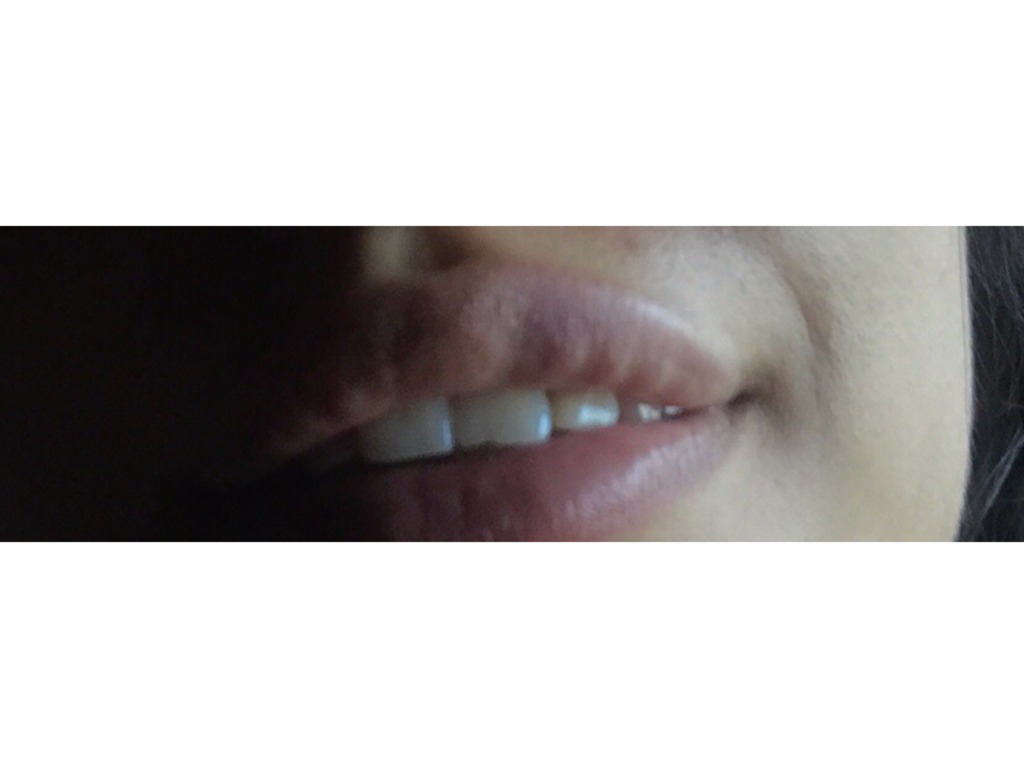 Фото 1. Шишечки после введения ювидерм ультра смайл