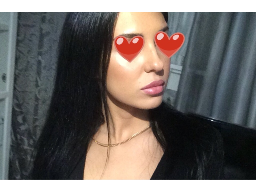 Фото 1. Есть ли противопоказания к ринопластике, если в носу есть radiesse?