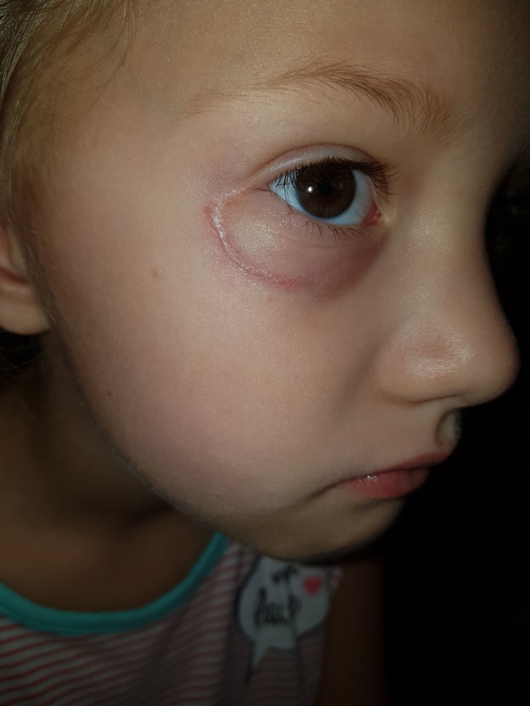 Фото 1. Как убрать рубец на нижнем веке?