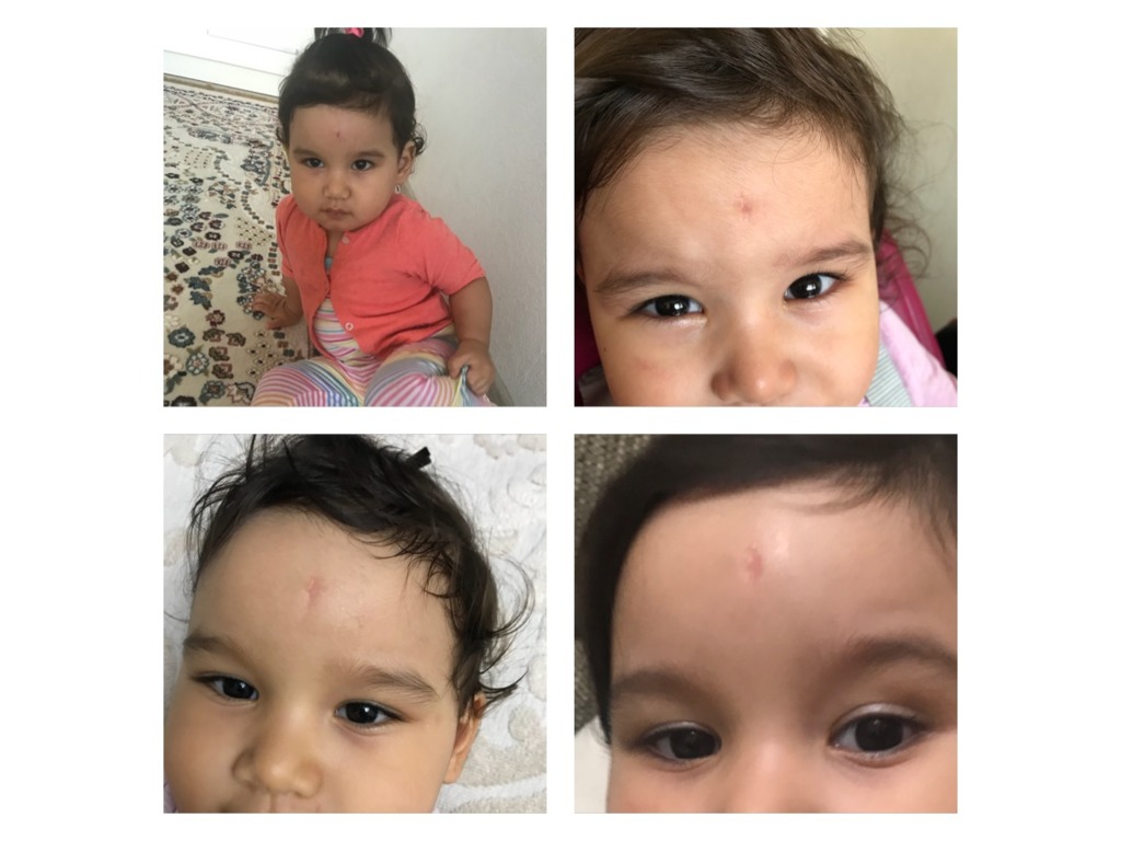 Фото 1. Как убрать рубец на лбу у ребенка?