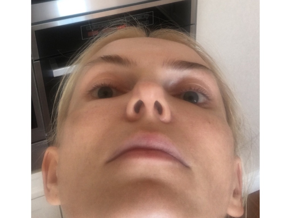 Фото 1. Нормально ли что сильный отек от Ювидерм волбелла и волюма?