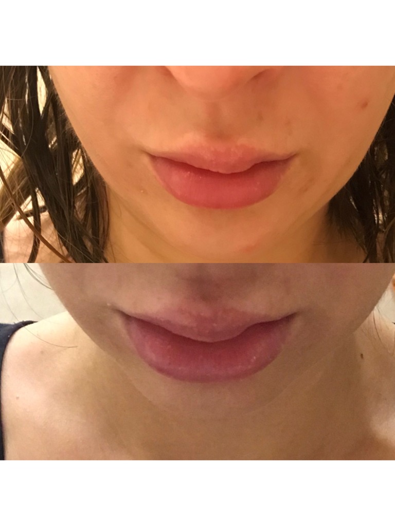 Фото 1. Рассосется ли уплотнение на губах после Ювидерм Волифт?