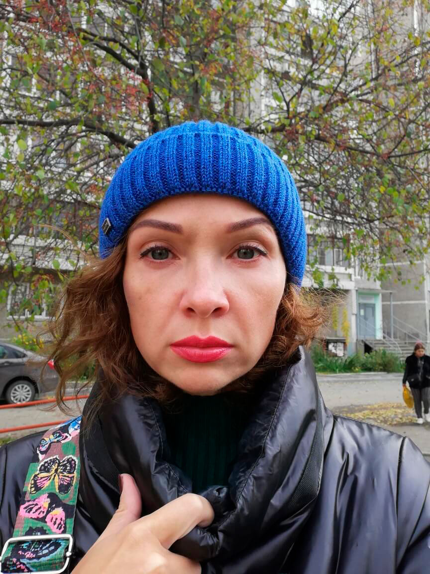 Фото 2. Какой метод эффективнее? Филлер на скулы или векторный лифтинг?