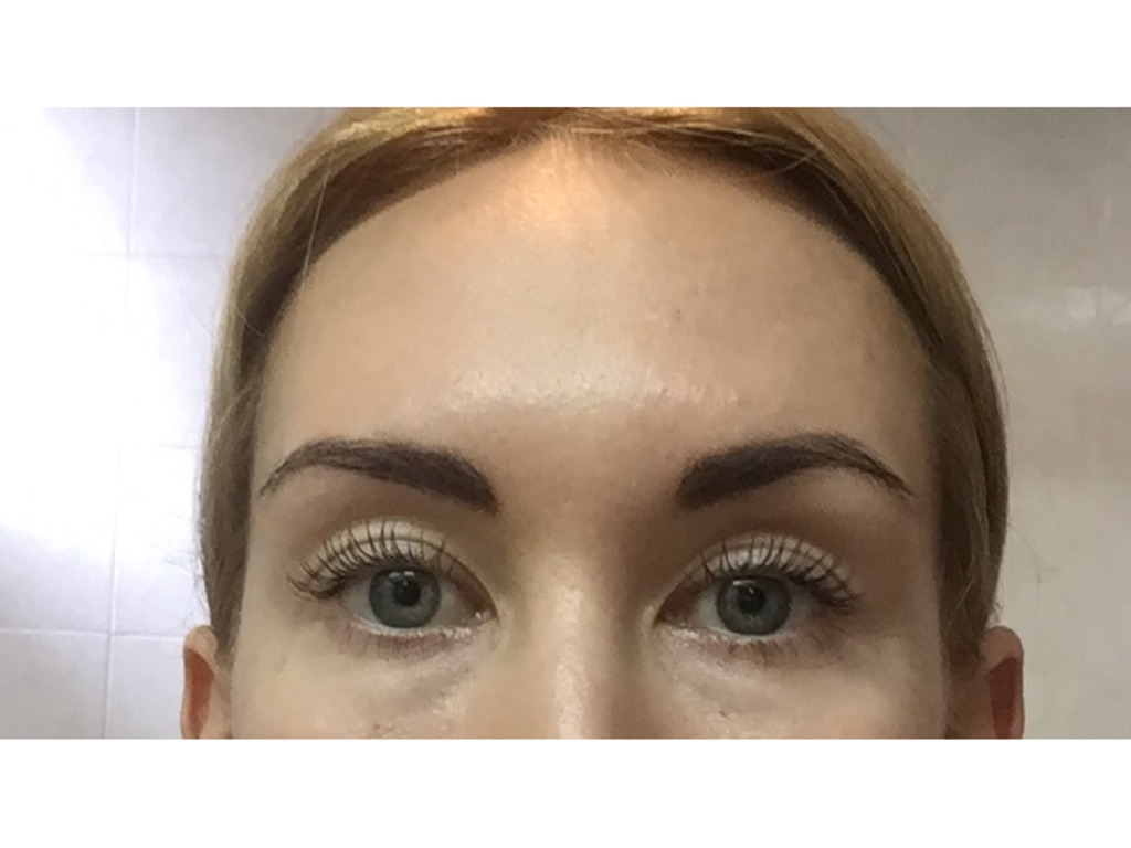 Фото 1. Что делать, если после Ксеомина приподнялась одна бровь и искривилась улыбка?