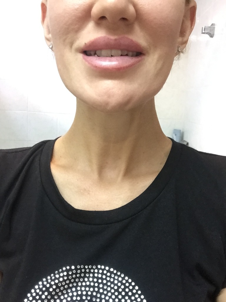 Фото 2. Что делать, если после Ксеомина приподнялась одна бровь и искривилась улыбка?