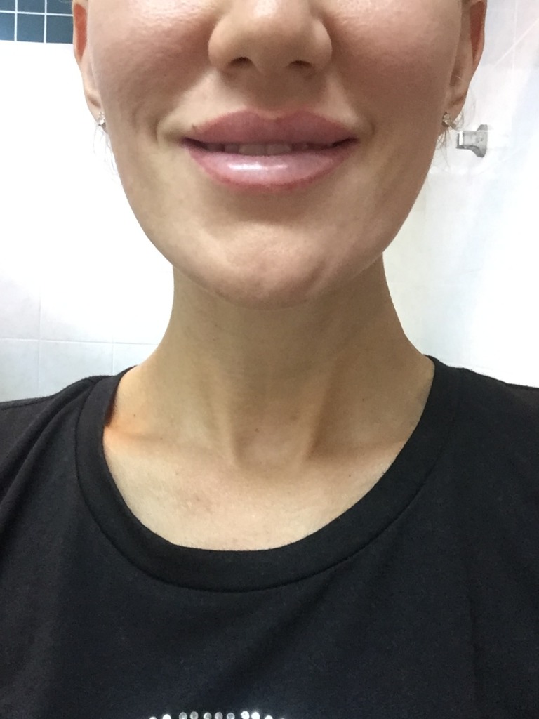 Фото 3. Что делать, если после Ксеомина приподнялась одна бровь и искривилась улыбка?