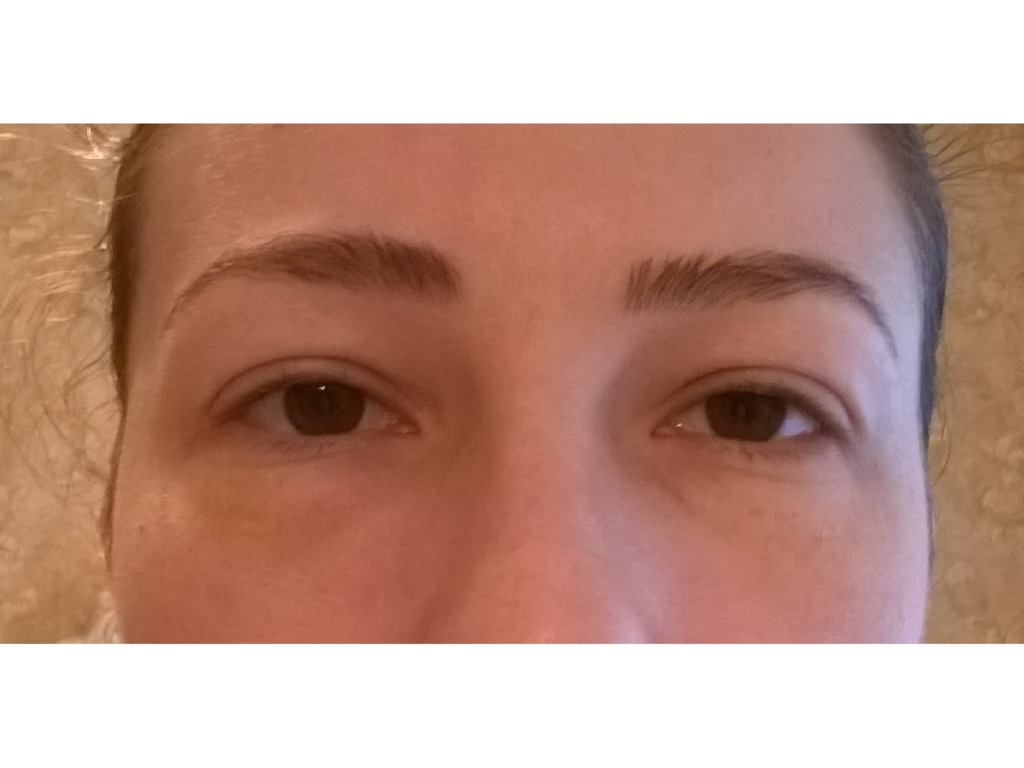 Фото 1. Есть ли смысл делать мезотерапию при выраженных мешках под глазами?