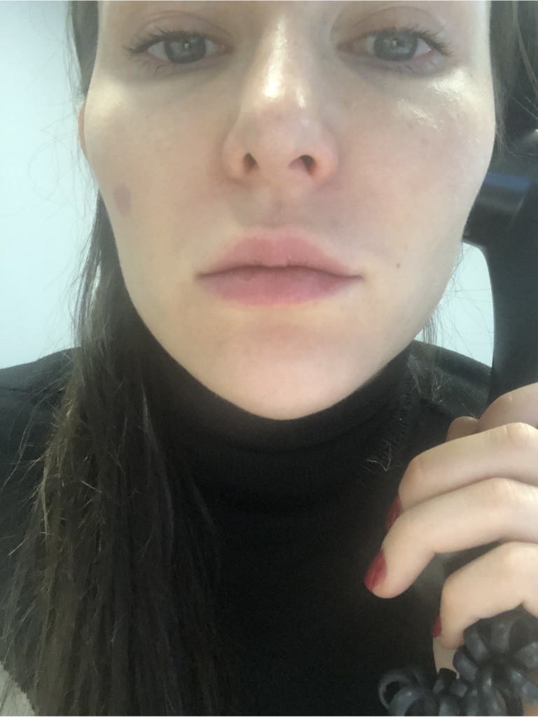 Фото 1. Что делать, если отекли филлеры спустя год?