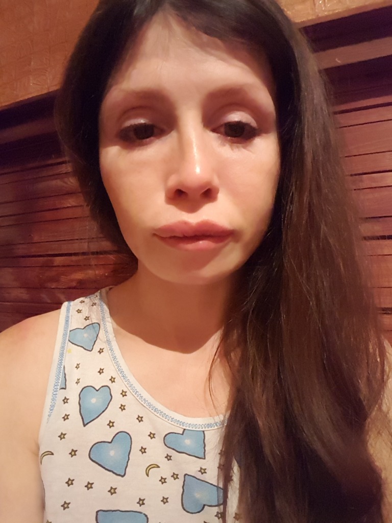 Фото 1. Что можно сделать с губой после удаления из нее геля, чтобы уменьшить и привести ее в нормальный вид?