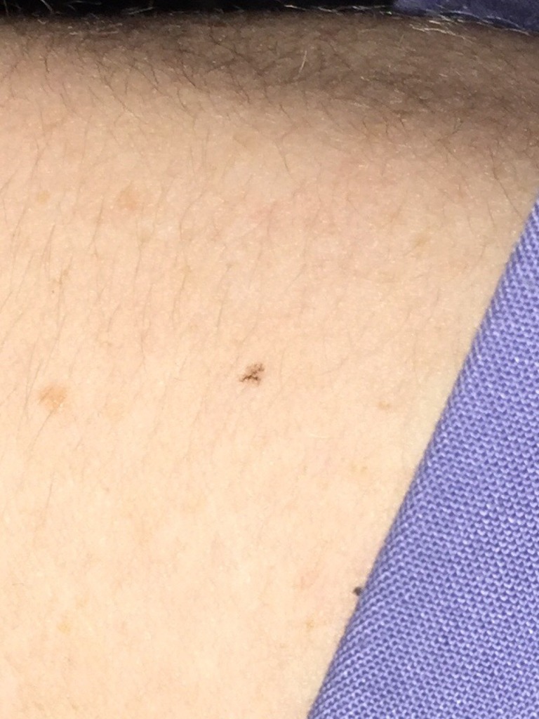 Фото 1. Не опасна ли родинка в моем случае?