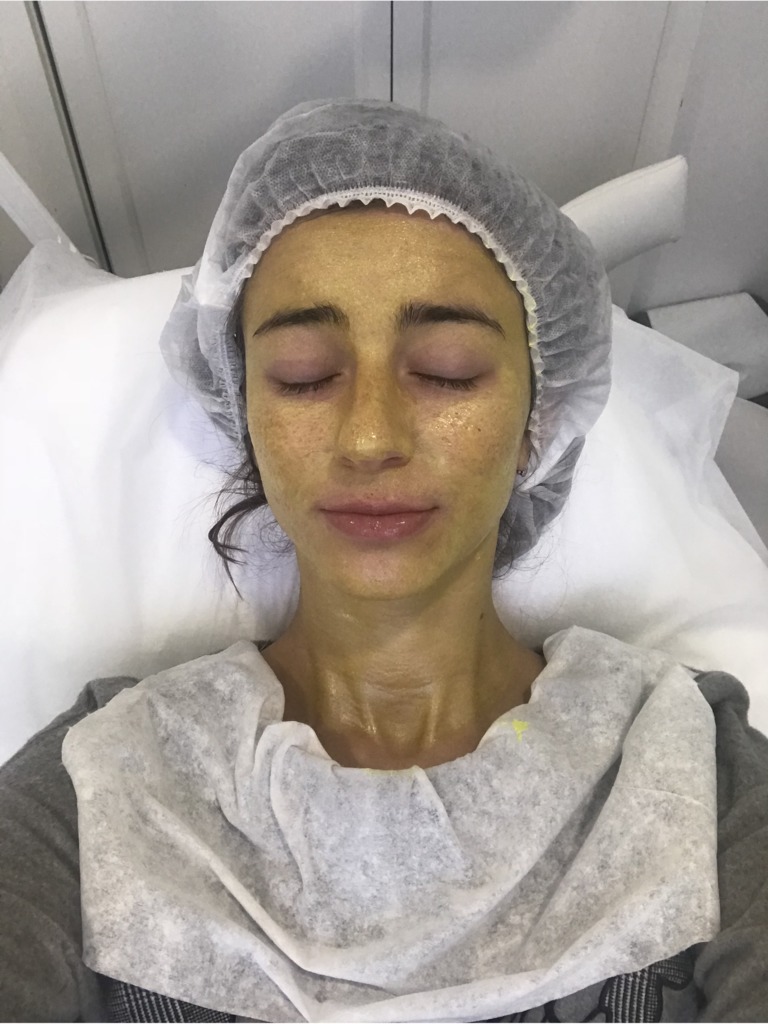 Фото 1. На какой срок нужно отложить беременность после применения ретиноевого пилинга?