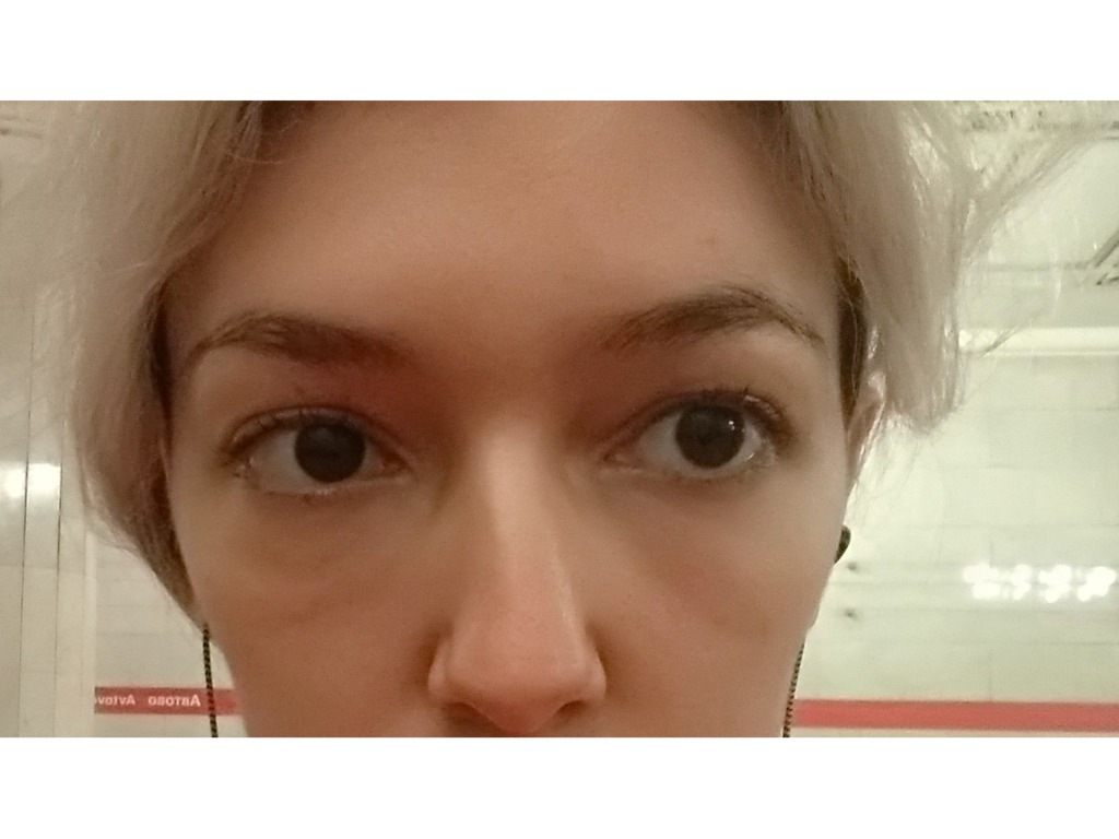 Фото 2. Неприятные ощущения и отек под глазами после филлера не проходят, как быть?