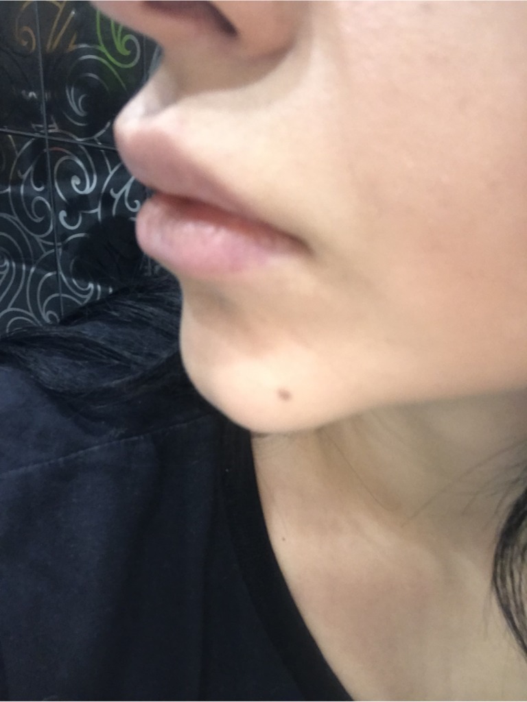 Фото 2. Как исправить ситуацию после неудачного увеличения губ?