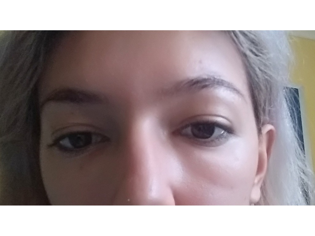 Фото 4. Неприятные ощущения и отек под глазами после филлера не проходят, как быть?