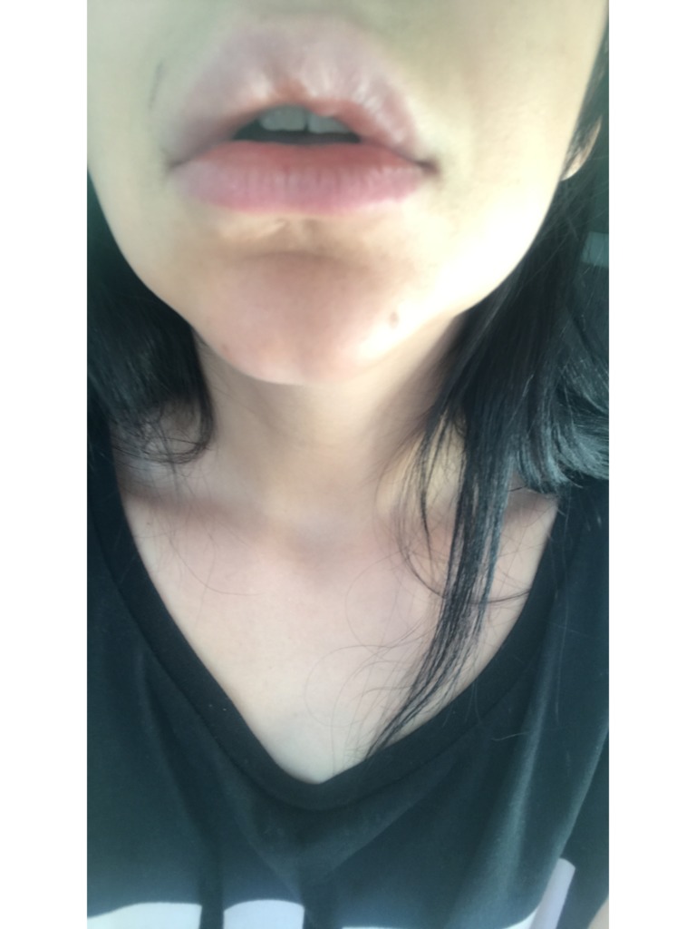 Фото 6. Как исправить ситуацию после неудачного увеличения губ?