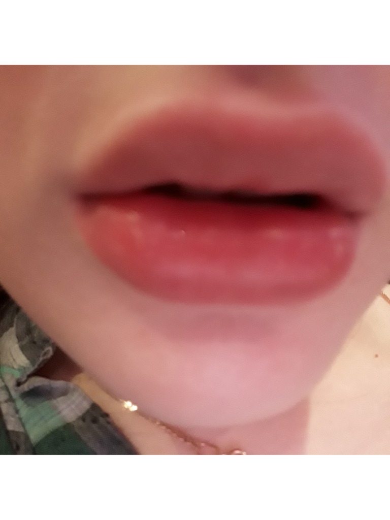 Фото 1. Если онемела губа, что можно сделать?