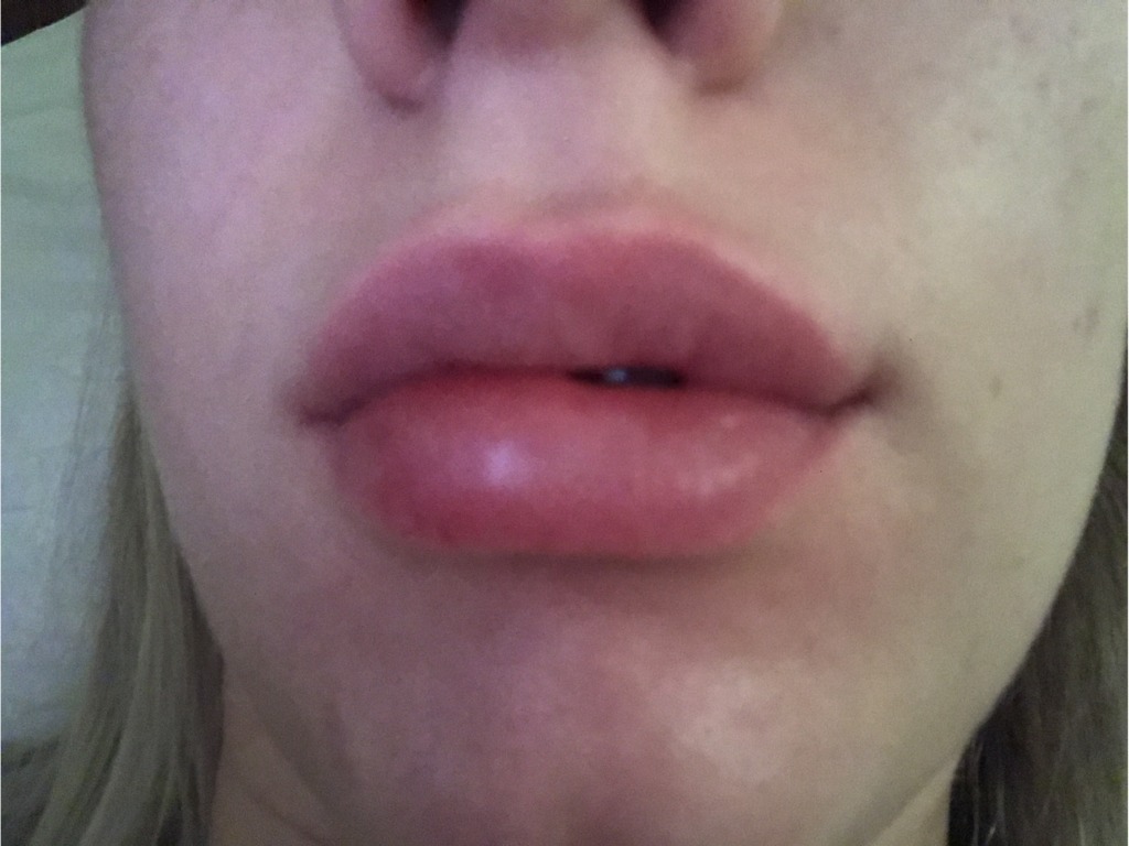 Фото 1. Что делать, если отекла губа в отпуске?