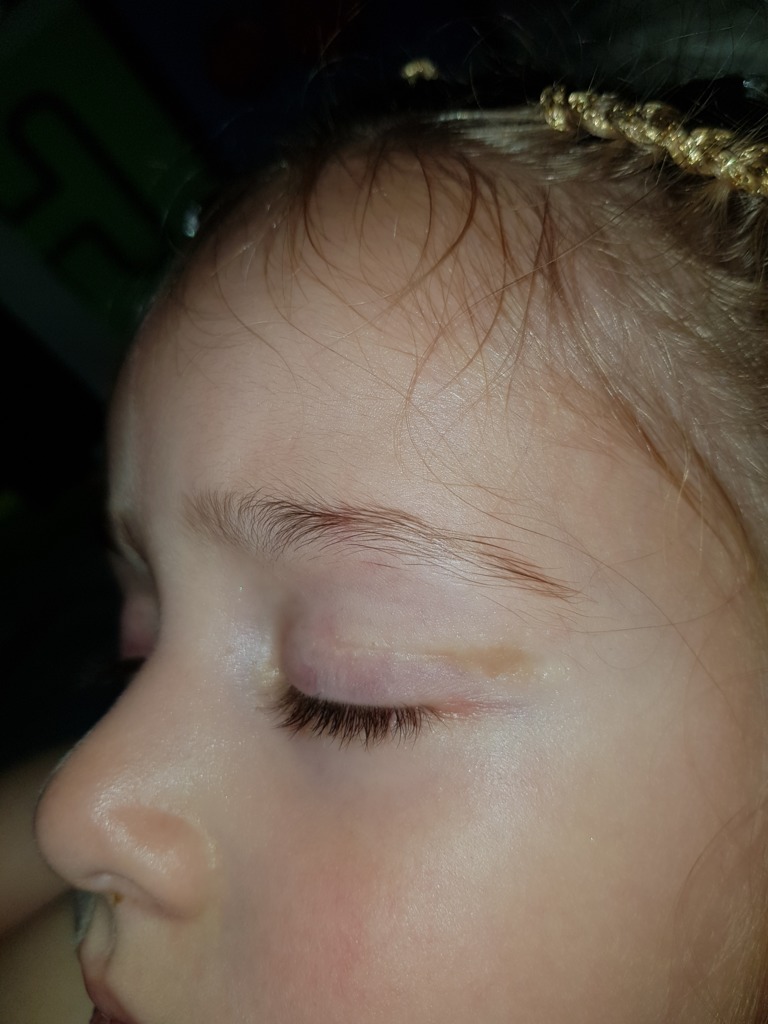 Фото 1. Можно ли делать лазерную шлифовку и пользоваться отбеливающимися средствами?