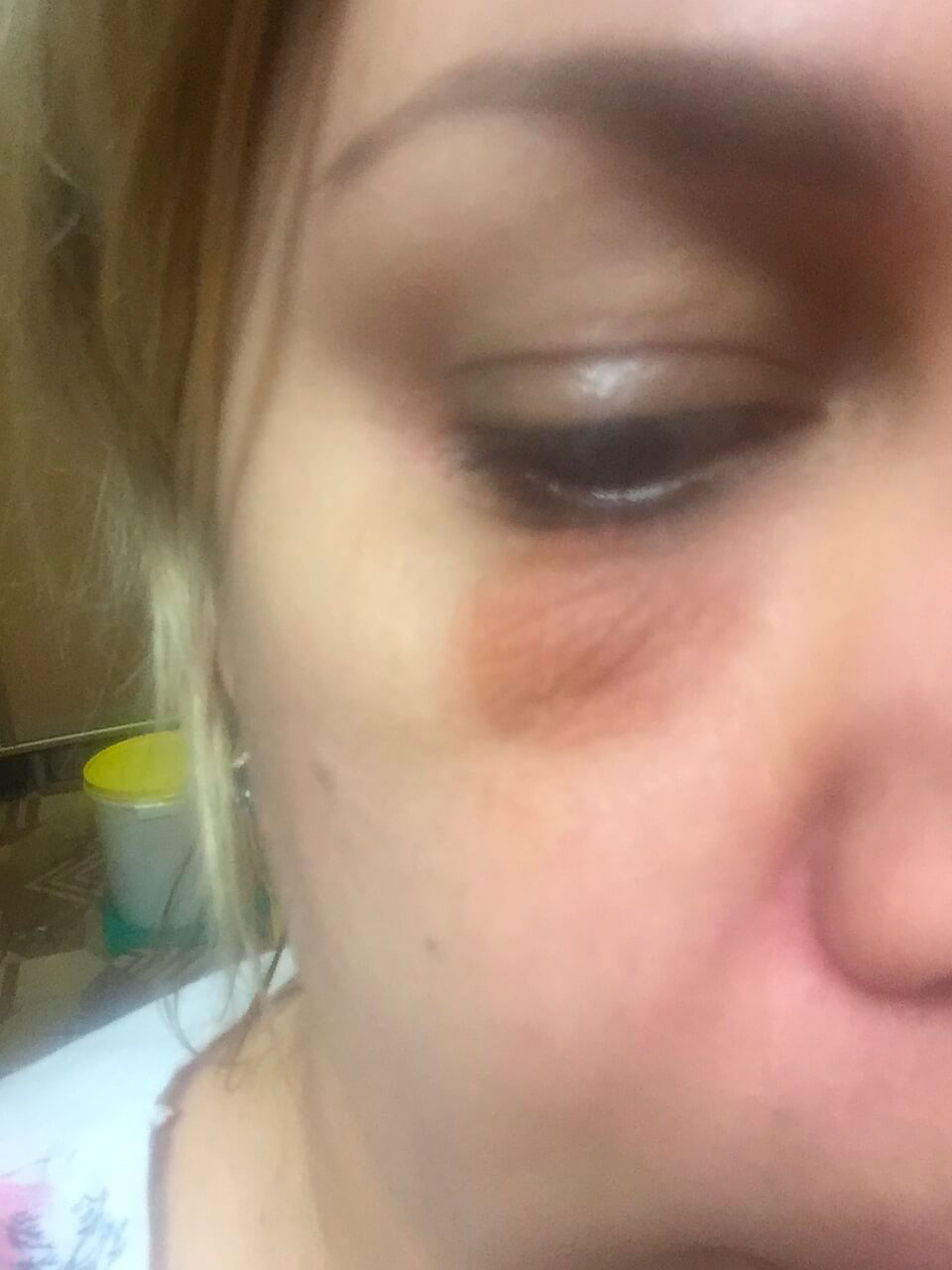 Фото 1. Почему под глазом шелушится и потемнела кожа спустя полгода после ботокса