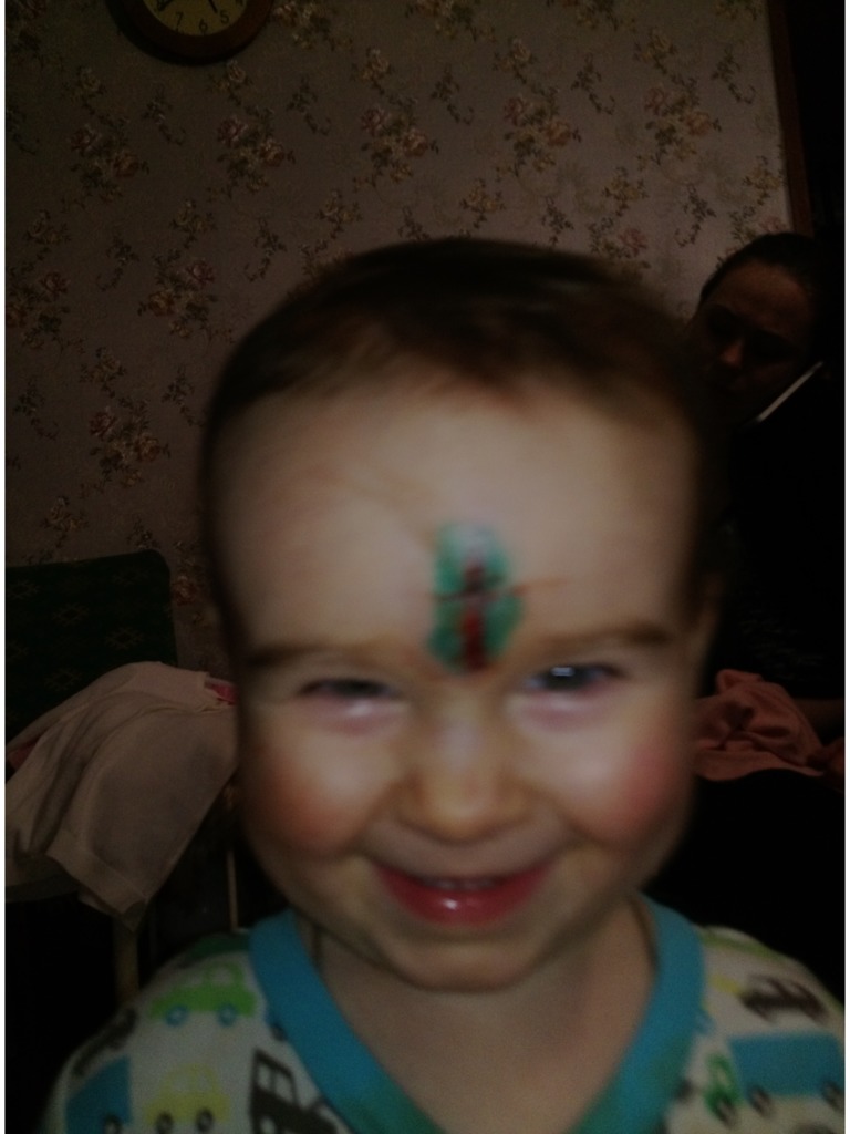 Фото 1. Что нужно делать, чтобы исправить ситуацию со шрамом у ребенка?