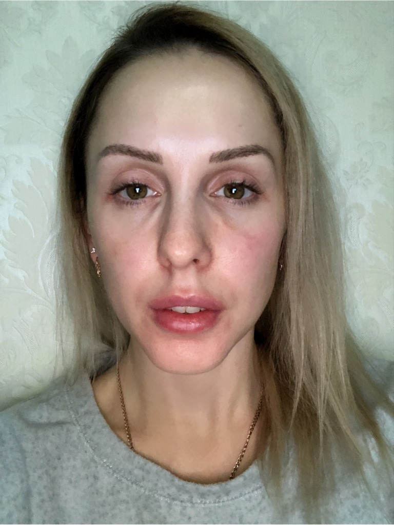 Фото 2. Вводить гиалуронидазу или ждать дальнейшего развития событий с носослезкой?