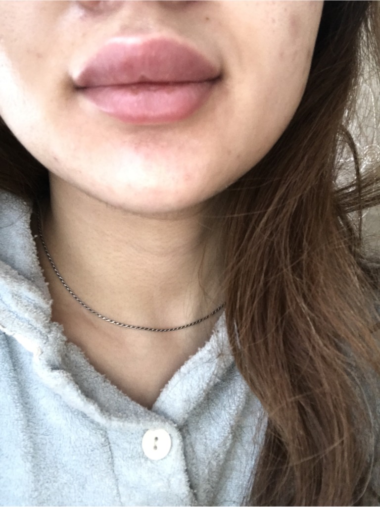 Фото 1. Что делать если увеличилась и припухла верхняя губа?