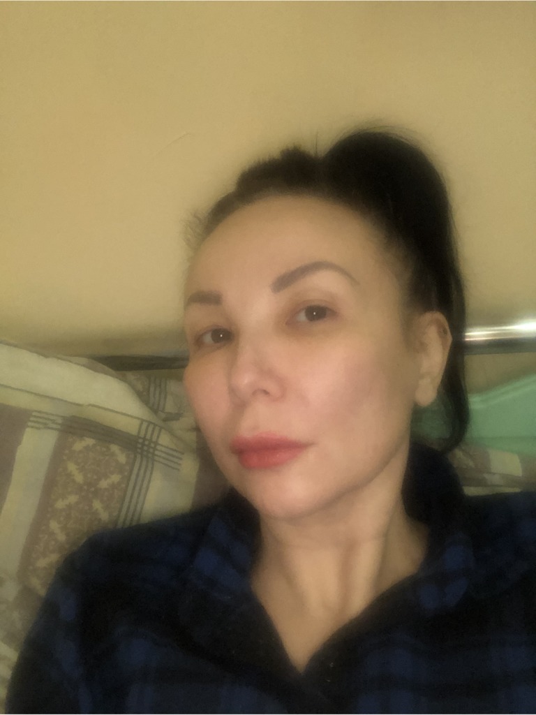 Фото 1. Могут ли инъекции гиалуроновой кислоты в губы и биоревилитлизация быть причиной отека Квинке?