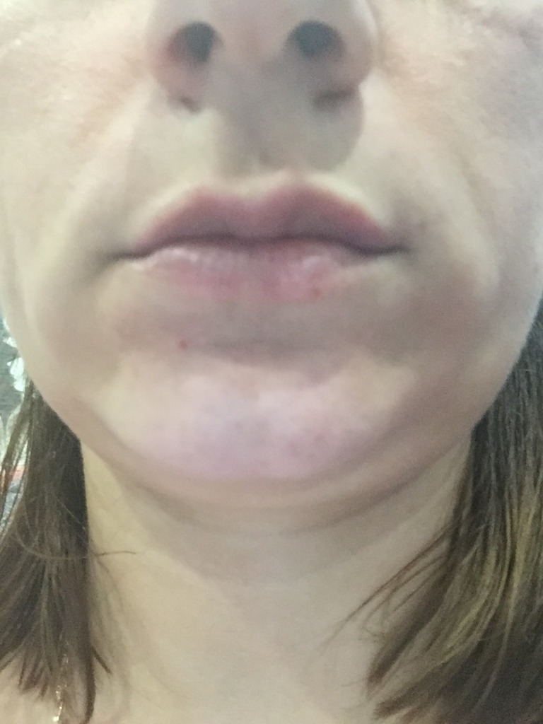 Фото 1. Сколько мл филлера нужно для увеличения губ?