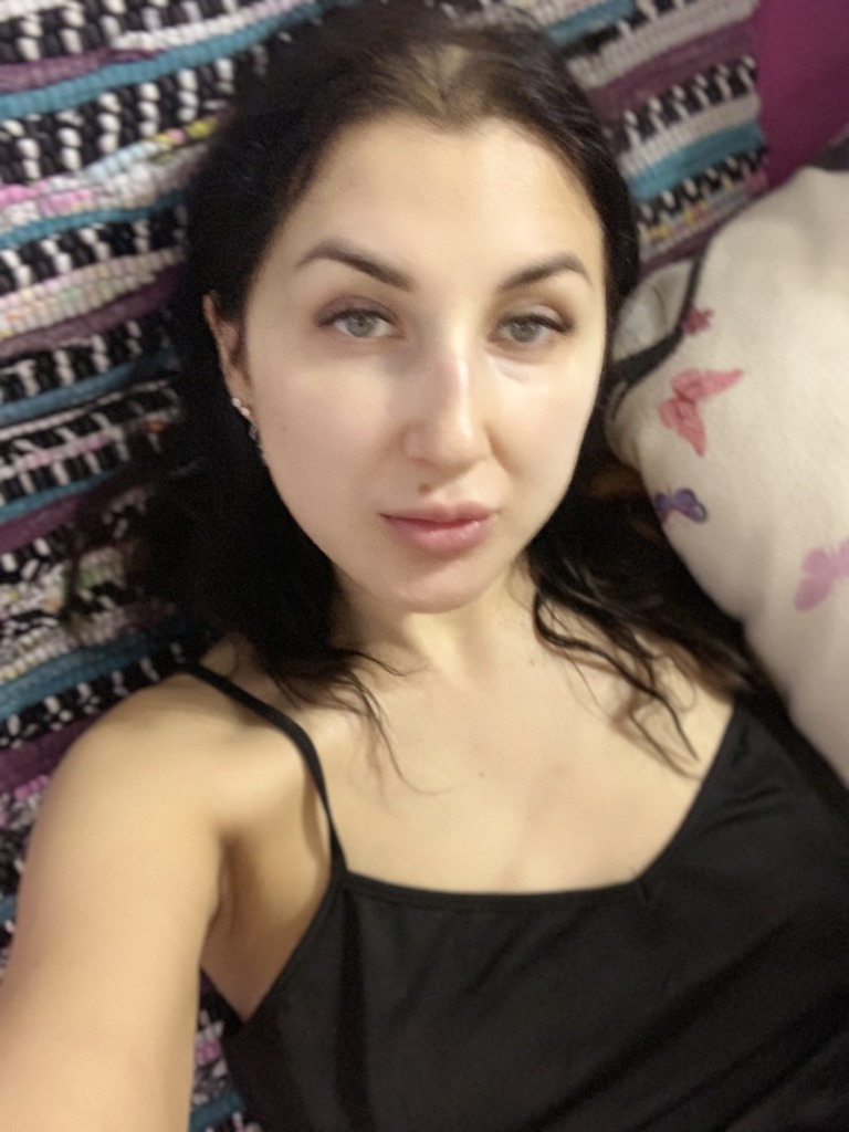 Фото 1. Можно ли сделать септоплатику и пластику носа вместе без последствий?