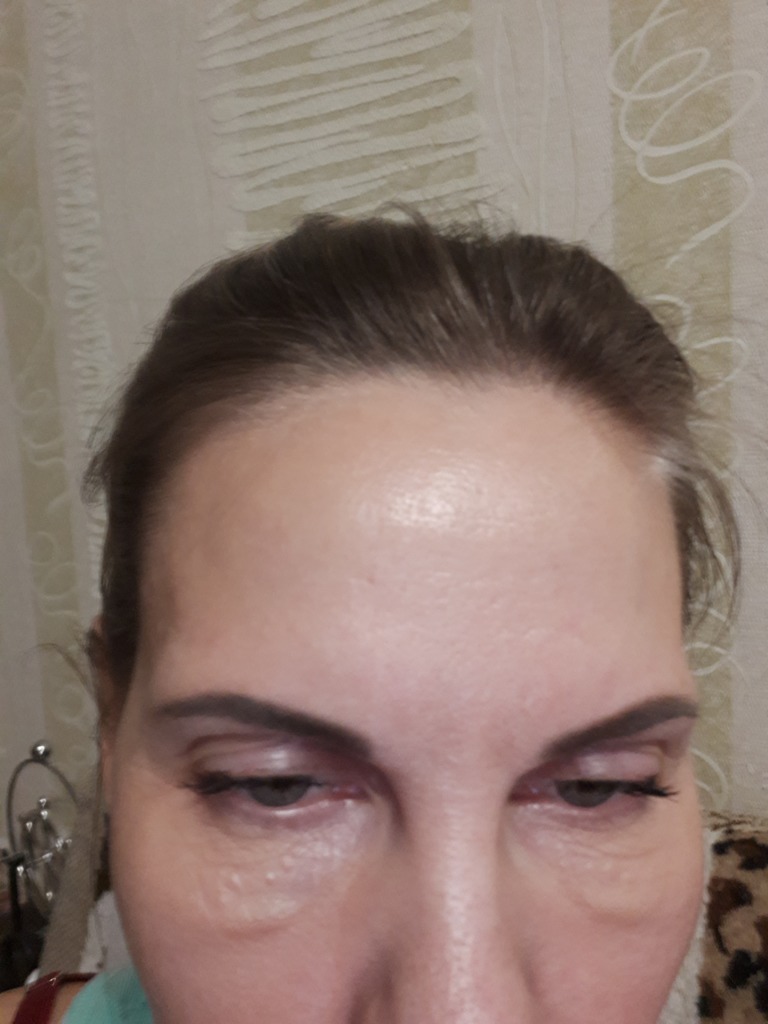 Фото 1. Что делать, если отеки не проходят?