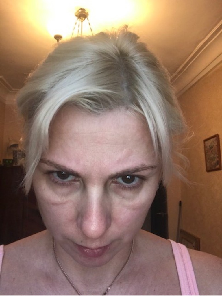 Фото 1. Как решить проблему мешков под глазами?