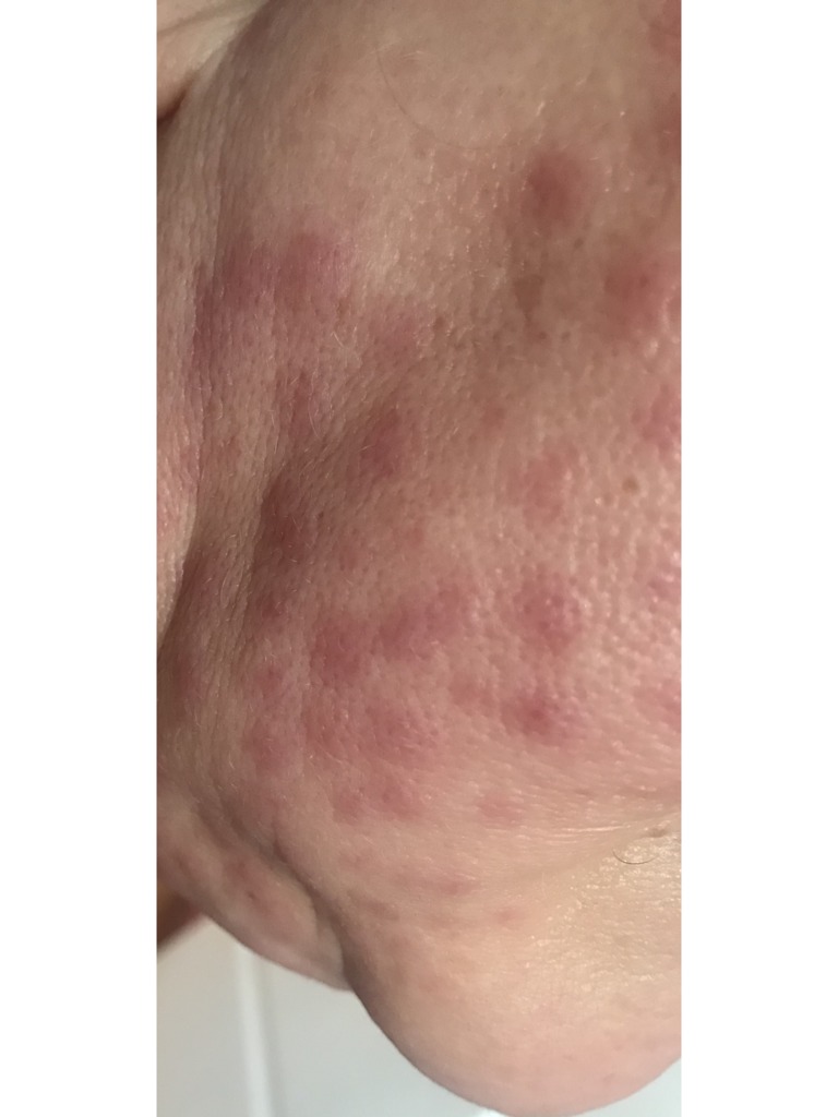 Фото 1. Нормальна ли такая ситуация после биоревитализации?