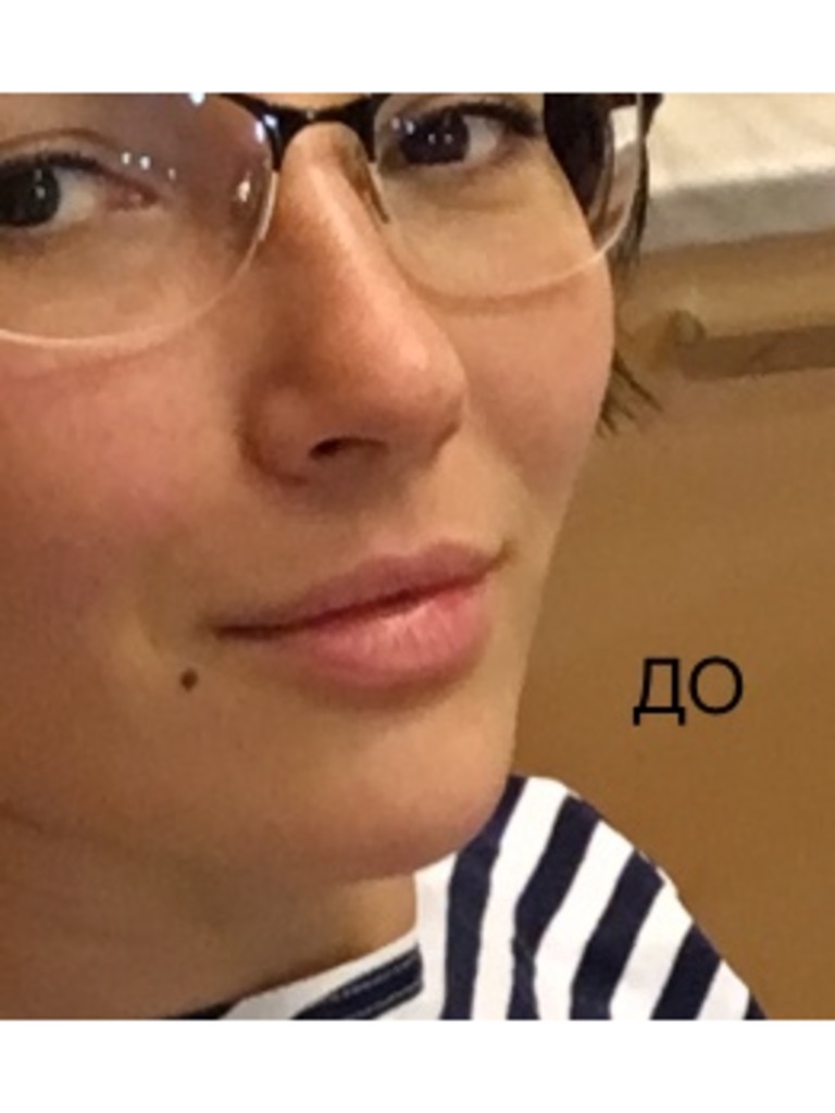 Фото 1. Можно ли расчитывать на бесплатную коррекцию в моем случае?