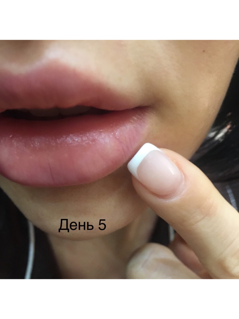 Фото 3. Можно ли расчитывать на бесплатную коррекцию в моем случае?
