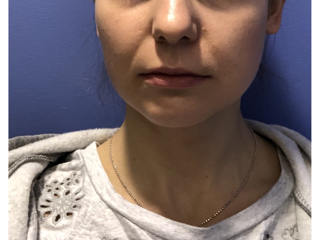 Фото 1. Есть ли показания для удаления комков Биша?