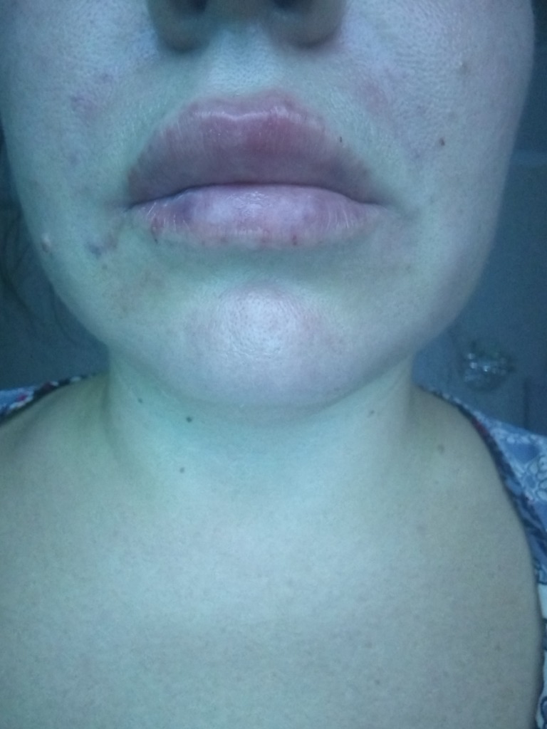 Фото 1. Болит губа и отекла, как снять симптомы?