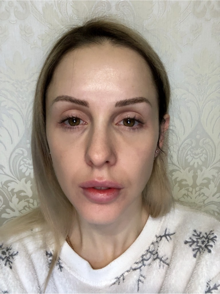 Фото 1. Как убрать провал, образовавшийся после выведения филлера?