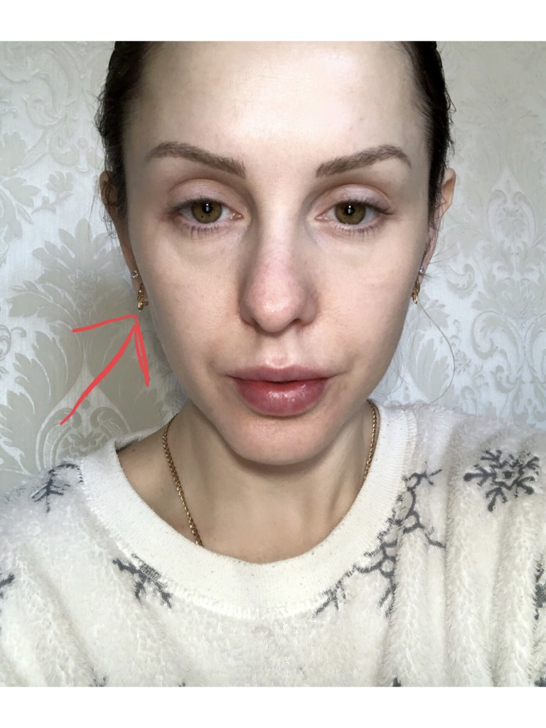 Фото 2. Как убрать провал, образовавшийся после выведения филлера?