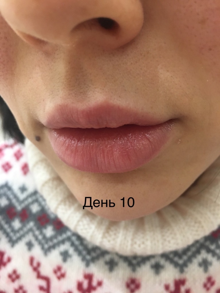 Фото 5. Можно ли расчитывать на бесплатную коррекцию в моем случае?