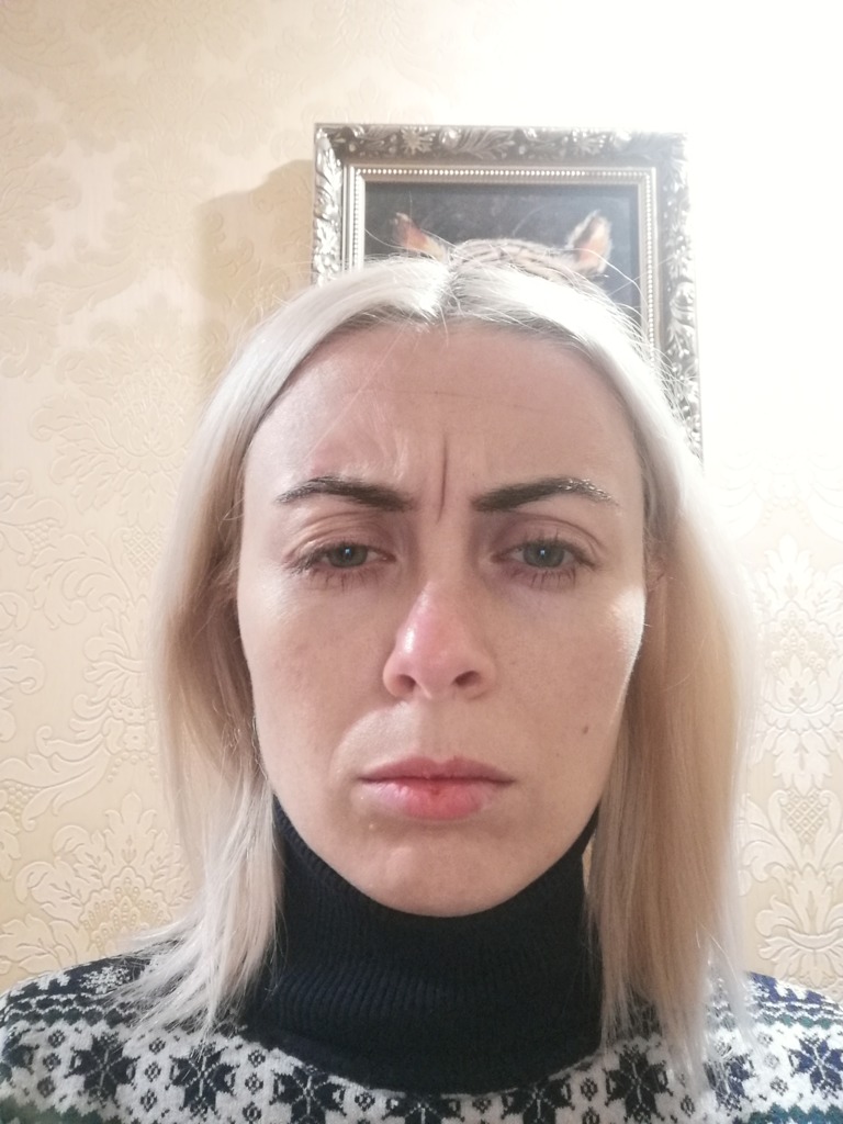Фото 2. Что делать, если после инъекций ботулотоксина ощущения напряженности в голове?