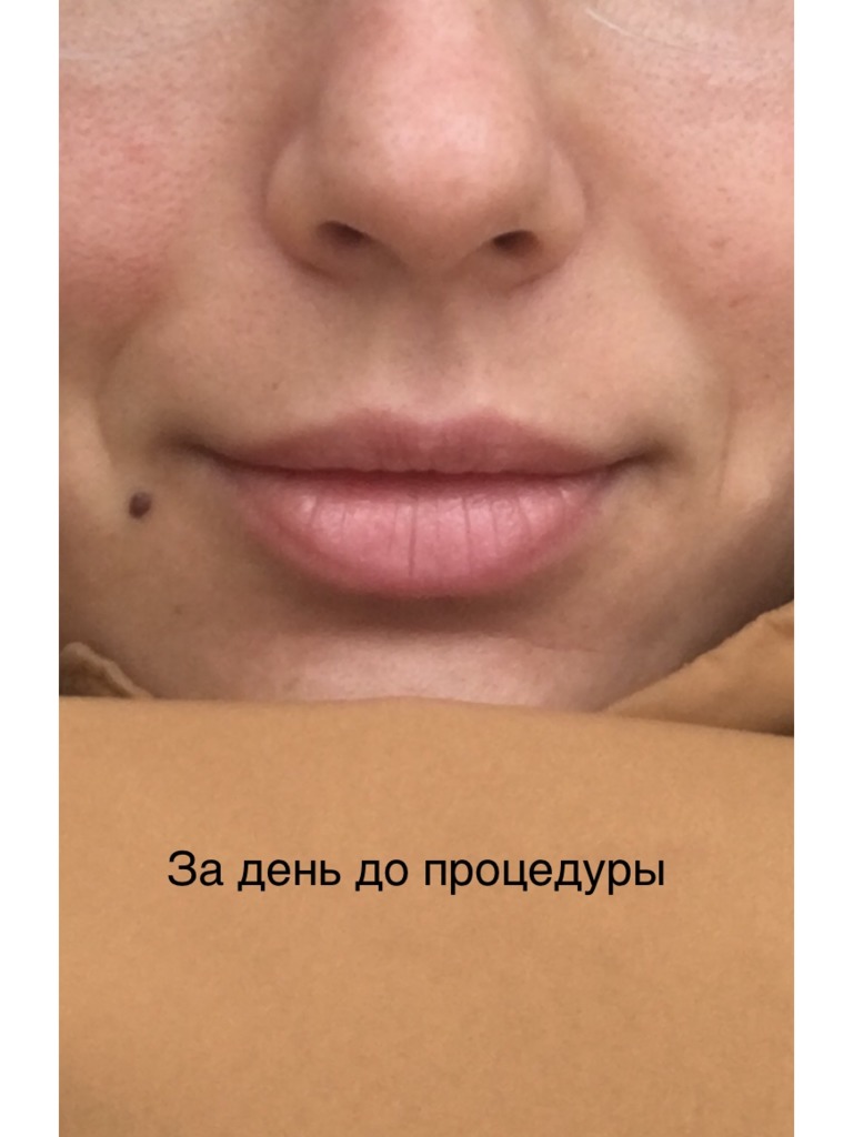 Фото 2. Можно ли расчитывать на бесплатную коррекцию в моем случае?