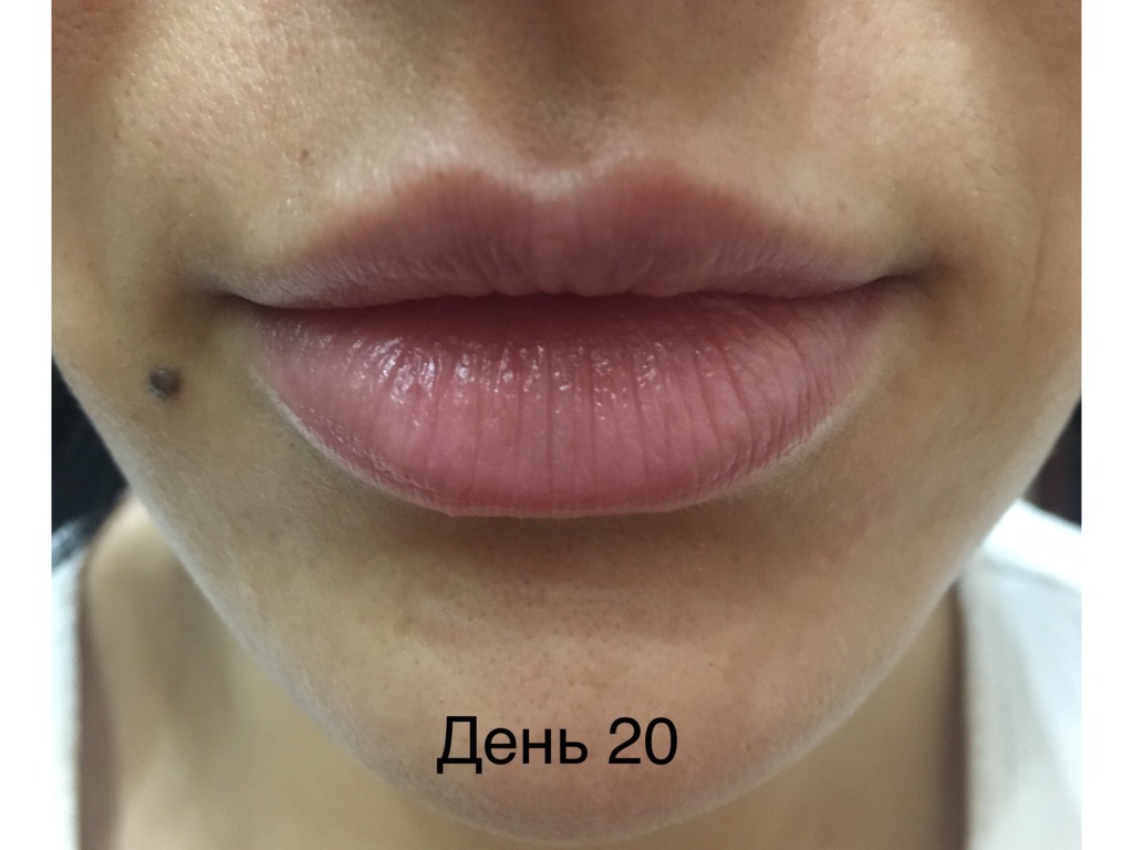 Фото 7. Можно ли расчитывать на бесплатную коррекцию в моем случае?