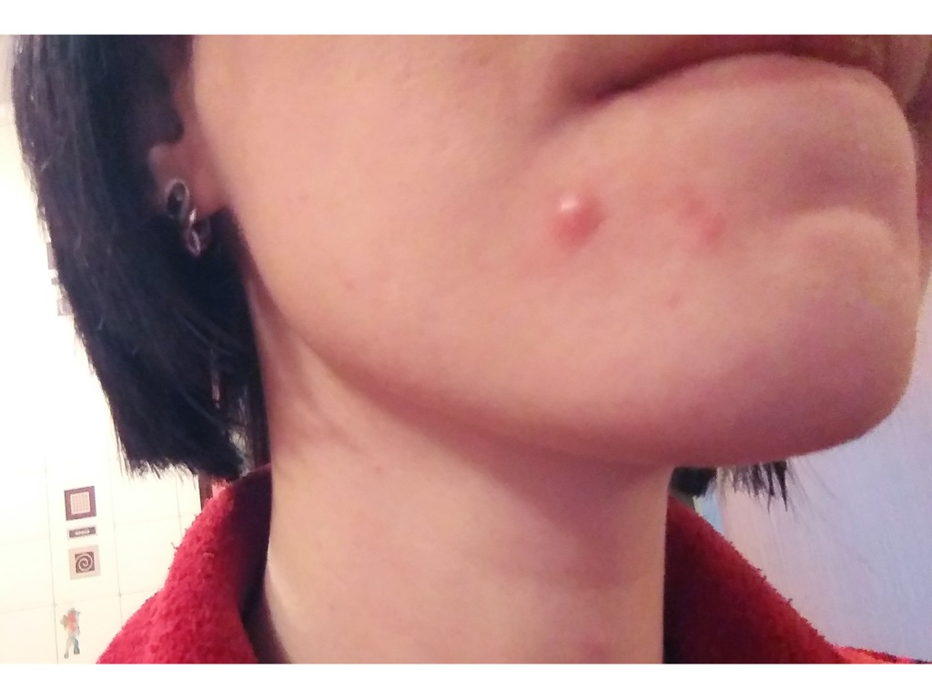 Фото 1. Каковы риски возникновения подкожных прыщей после коррекции скул?