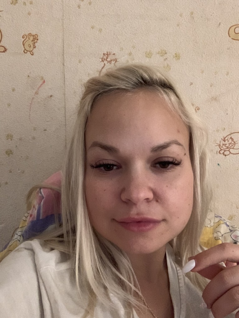 Фото 2. Не проходит отек над губой после Ювидерма 2 недели, посоветуйте что делать?