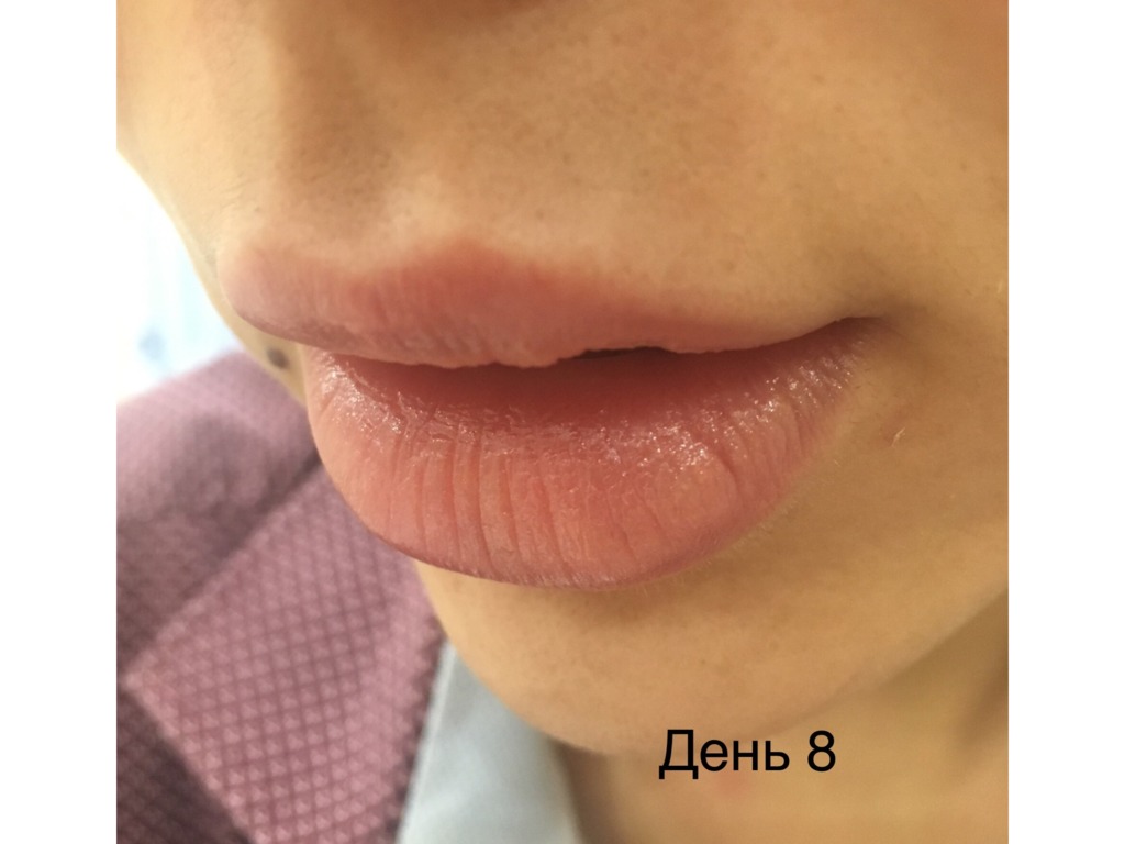 Фото 4. Можно ли расчитывать на бесплатную коррекцию в моем случае?