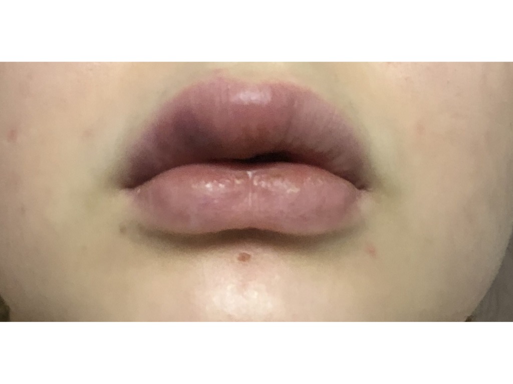 Фото 1. Не сходит отек, как можно его снять?