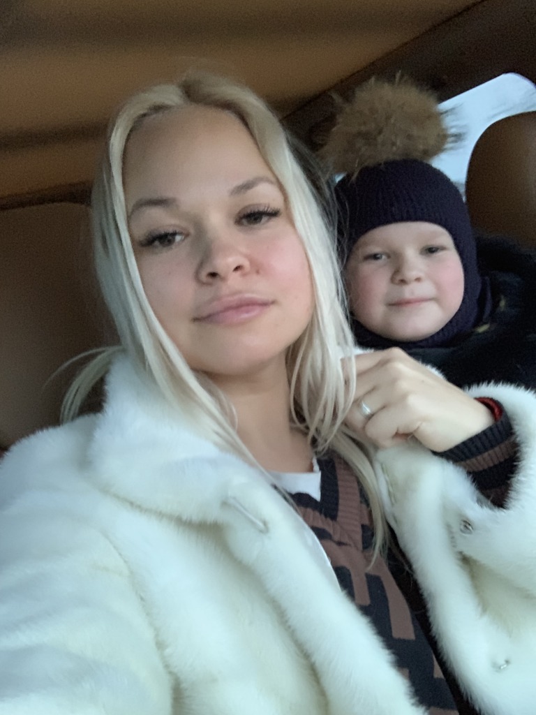 Фото 1. Не проходит отек над губой после Ювидерма 2 недели, посоветуйте что делать?