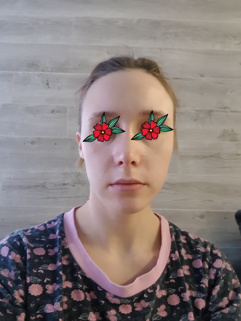 Фото 1. Что делать если не спадает температура после ринопластики?