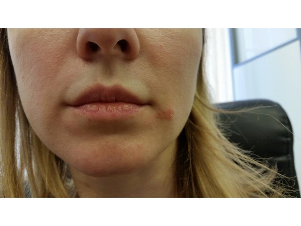 Фото 3. Как убрать деформацию над губой после филлера Stylage спутя 3 года?