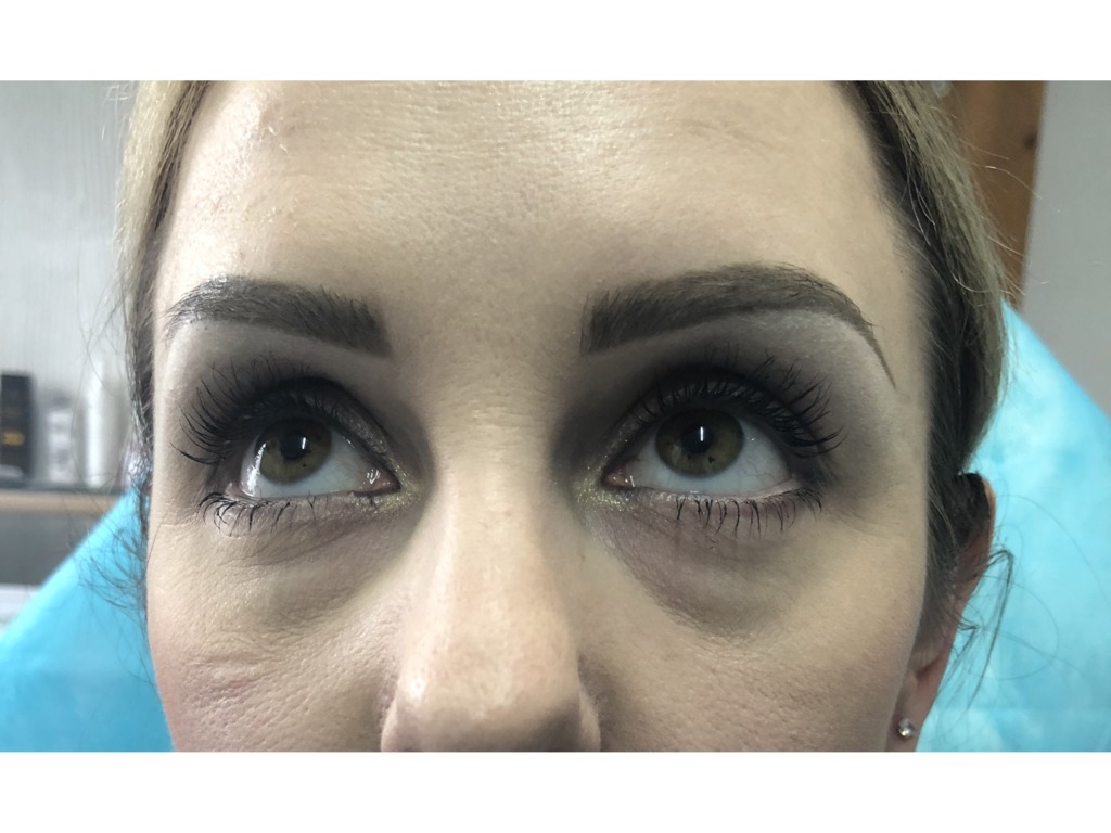 Фото 2. Почему появились отеки и как их убрать?